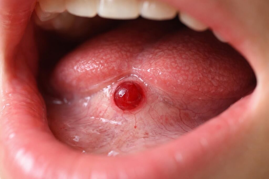 Quand la boule de sang sous la langue devient-elle préoccupante ?