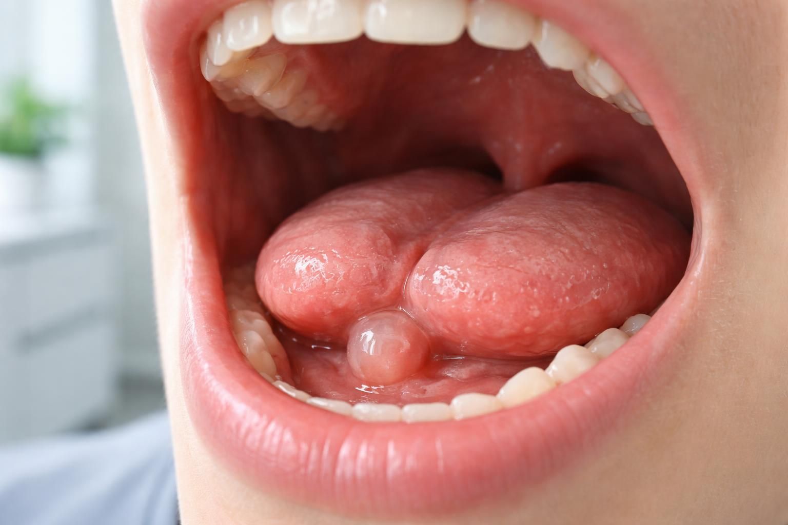 découvrez les causes possibles d'une boule sous la langue, leurs symptômes, et quand consulter un professionnel de santé pour un diagnostic précis.